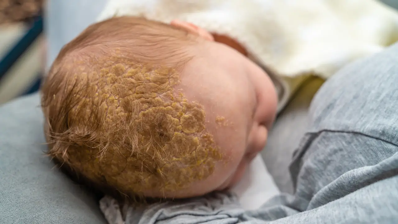 Cradle cap in babies